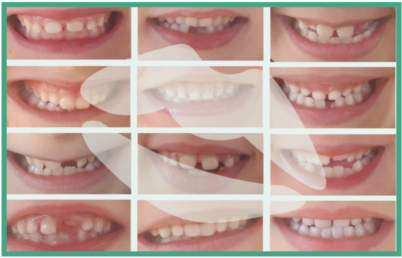 L'hygiène dentaire des dents de lait